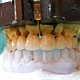 Imagine Lucrari dentare portelan