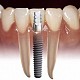 IMPLANT DENTAR la doar 900LEI Imagine IMPLANT DENTAR la doar 900LEI