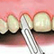 Sfaturi de urmat dupa o extractie dentara Imagine Sfaturi de urmat dupa o extractie dentara