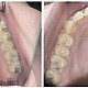 Aparat dentar pentru corectarea înghesuirilor dentare Imagine Aparat dentar pentru corectarea înghesuirilor dentare