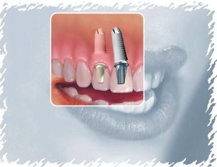 Imagine Oferta implant dentar sector 6