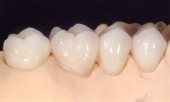 Imagine Ceramica pe Zirconiu