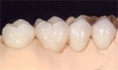 Imagine Estetica dentara- Lucrari protetice