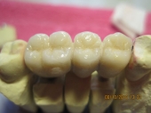 Imagine Promotie coroane dentare HERACERAM 