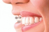 Imagine Aparat dentar invizibil