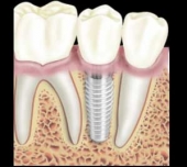 Imagine Implant dentar Otopeni