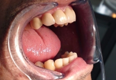 Imagine Ceramica presata E-Max in estetica dentara