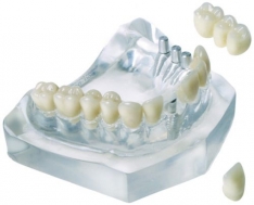 Imagine Implantul dentar 100%