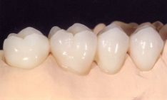 Imagine Ceramica pe Zirconiu