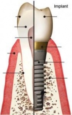 Imagine About dental implants
