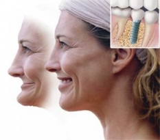 Imagine Implant dentar de calitate!