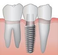 Imagine Implantul dentar - pot sa imi pun implant dentar?