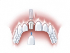 Imagine Implantul dentar