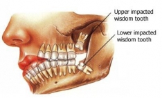 Imagine Indicatii post-operatorii dupa interventii chirurgicale oro-dentare!