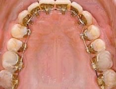 Imagine Aparatul Dental Lingual - Incognito 