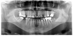 Imagine Avantajele radiografiei digitale in comparatie cu cea clasica