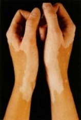 Imagine Vitiligo la copii si la adulti