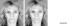 Lifting facial dentar sau chirurgical?