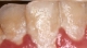 Placa bacteriana