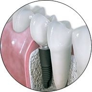 Imagine Dentsplai