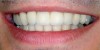 Coroane dentare metalo-ceramice sau zirconiu, Eurodent Millenium