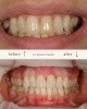 Fatete dentare Sector 4 - Dental Zen Estetic
