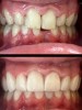 Fatete dentare Timisoara - DentalTours