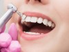 Imagine Igienizare dentara Sector3 - Clinica Zambetului