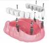 Implant dentar Buzau - DentalBlue