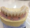 Implant dentar Pitesti Clinica Dr. Alecsandrescu