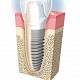 Imagine Promotia primaverii: implantul dentar