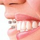 Imagine Aparat dentar invizibil
