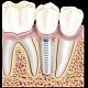 Imagine Implant dentar Otopeni