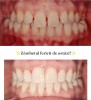Reducere aparat ortodontic Cluj - DentaCare