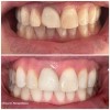 Restaurare dinte crapat - Dr. Clinica Dr. Alecsandrescu