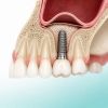 Sinus lift – soluția pentru implanturi atunci când volumul osos este insuficient