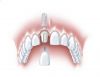 recomandari implant dentar