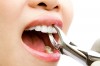 Sfaturi de urmat dupa o extractie dentara