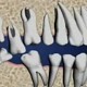 Migrarea dintilor dupa extractia dentara
