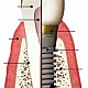 About dental implants