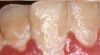 Placa-bacteriana-formare-localizare