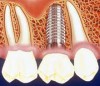 Intrebari si raspunsuri despre implant dentar