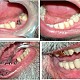 Reabilitarea aparatului dento-maxilar prin implanturi dentare