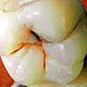 Cum sa descoperim singuri caria dentara ?