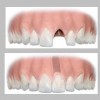 Inlocuire dinte cu implant dentar 450Euro