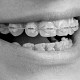 Tratamentul ortodontic interceptiv