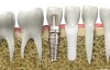 etape parcurse pentru un implant dentar