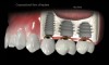 sinus lift implant dentar
