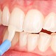 Fluorizarea si desensibilizarea dentara