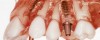 respingerea unui implant dentar